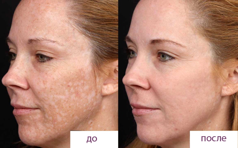 Ретиноевый пилинг фото до и после