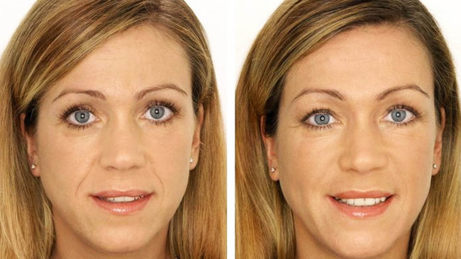 микротоки фото до и после