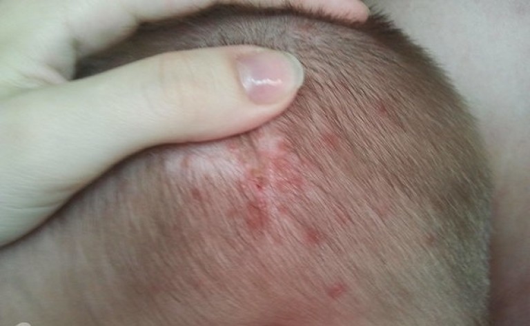 Почему появляются прыщи на голове