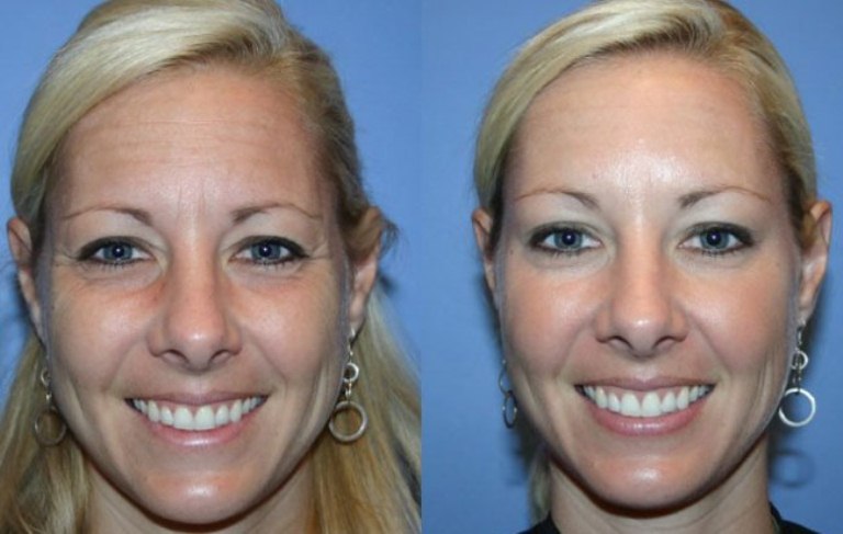 Фото до и после Ксеомина