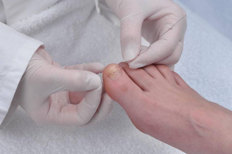 Вставляется скоба от вросшего ногтя