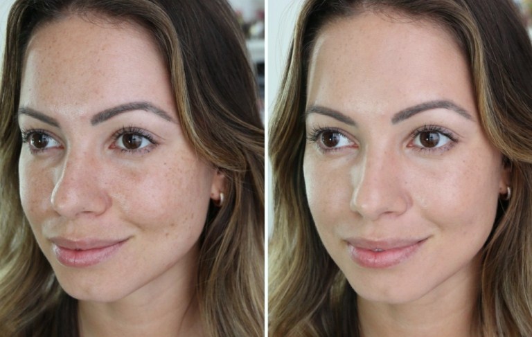 До и после миндального пилинга