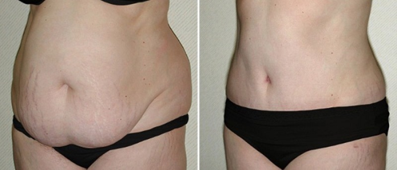 Результат после абдоминопластики на фото