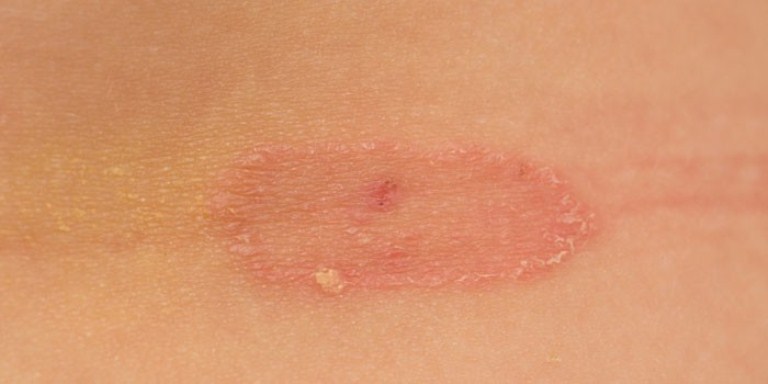 Лишай стригущий у человека