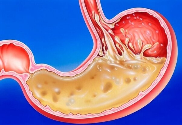 Повышенная кислотность желудка Повышенная кислотность желудка