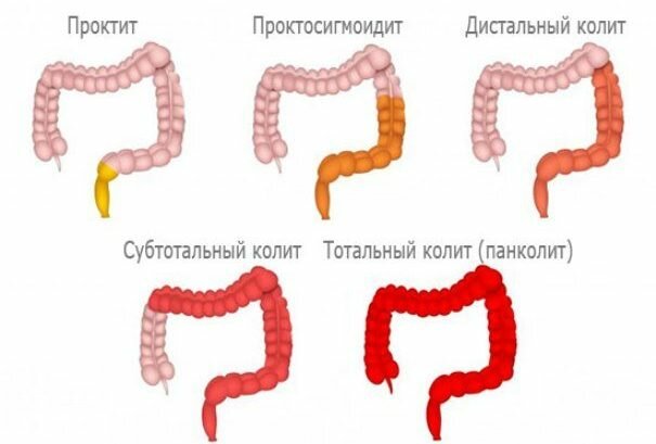 Типы колита