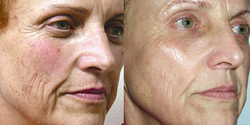 Ревитализация до и после 2