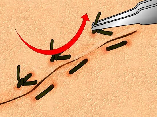 схема как снять, пинцет