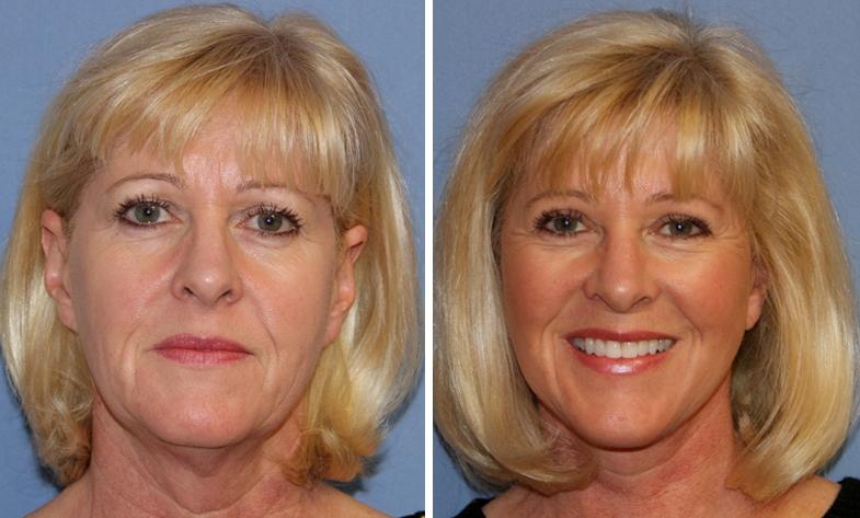 До и после круговой подтяжки лица