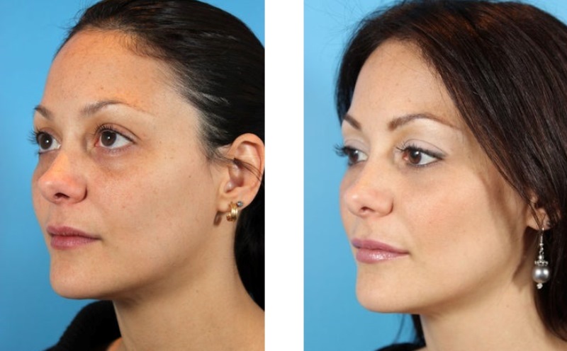 Биоревитализация Ялупро: до и после