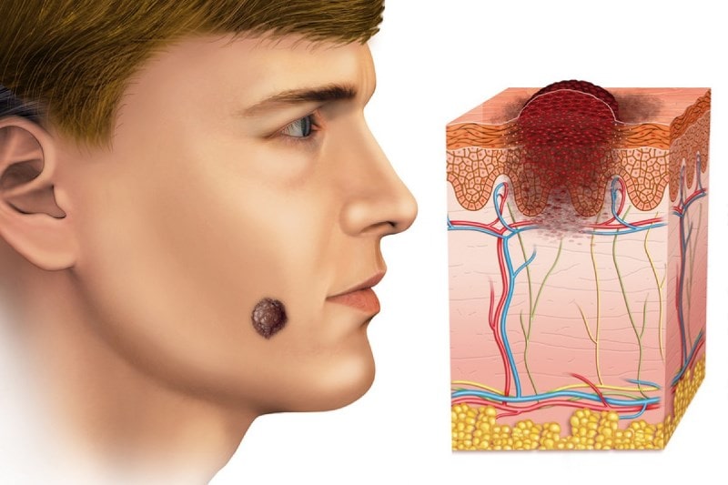 Базалиома кожи лица и ее схема