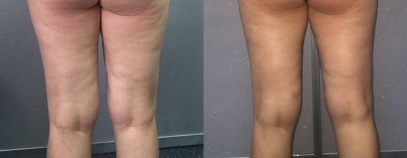 Антицеллюлитный массажер: фото до и после