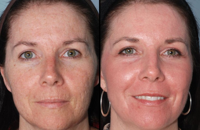 До и после лазерной шлифовки лица