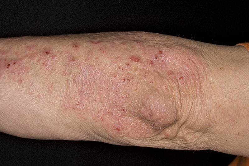 АТОПИЧЕСКИЙ ДЕРМАТИТ НА ЛОКТЯХ