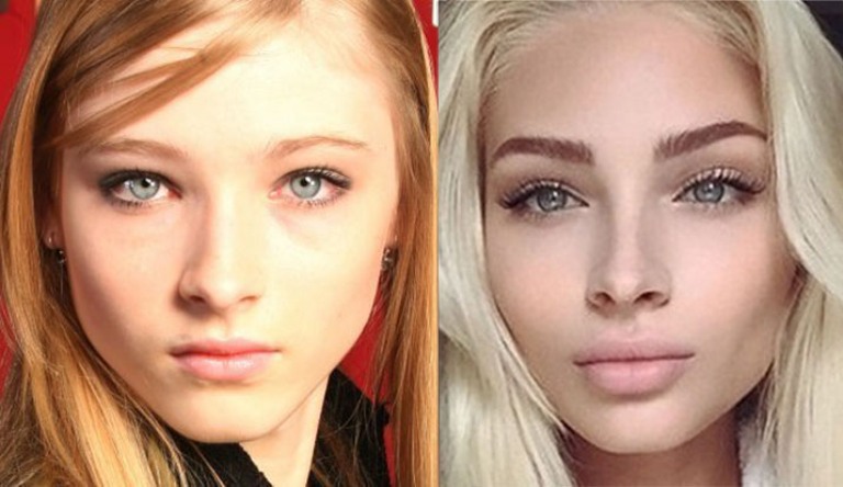 Алена Шишкова на фото до и после пластики лица