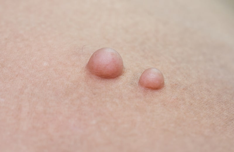 Атерома на лице и ее фото