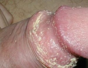 Белый налет на головке у мужчин