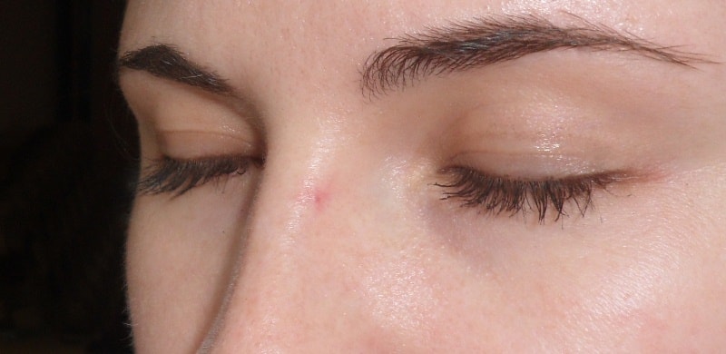 Базалиома носа