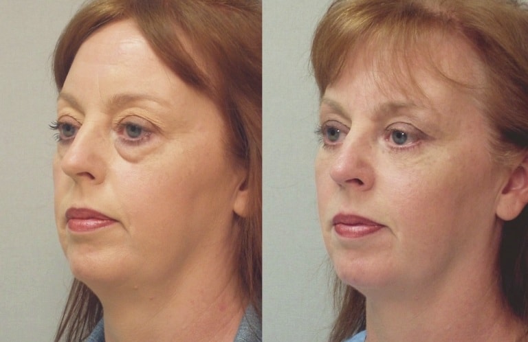 Лазерная блефаропластика: фото до и после