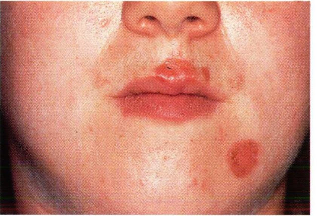 chto-takoe-streptodermiya-foto-1