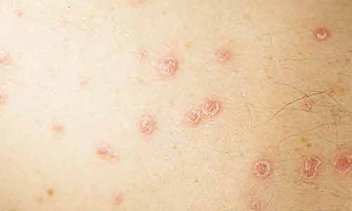 chto-takoe-streptodermiya-foto