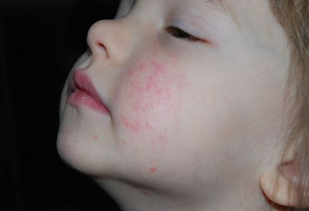 Что такое стрептодермия у детей