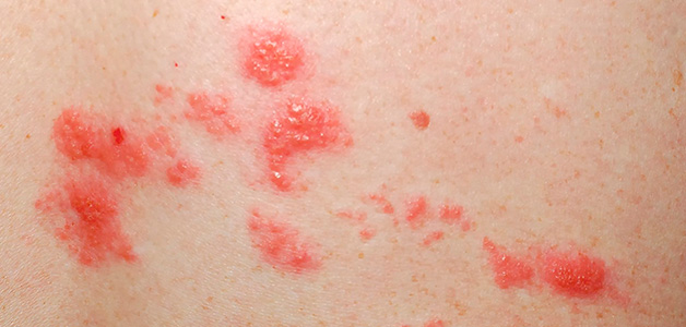 chto-takoe-streptodermiya