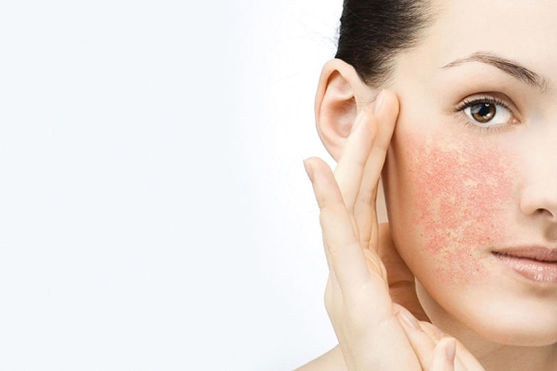 У девушки рожистое воспаление на лице