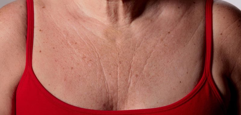 Морщины на теле