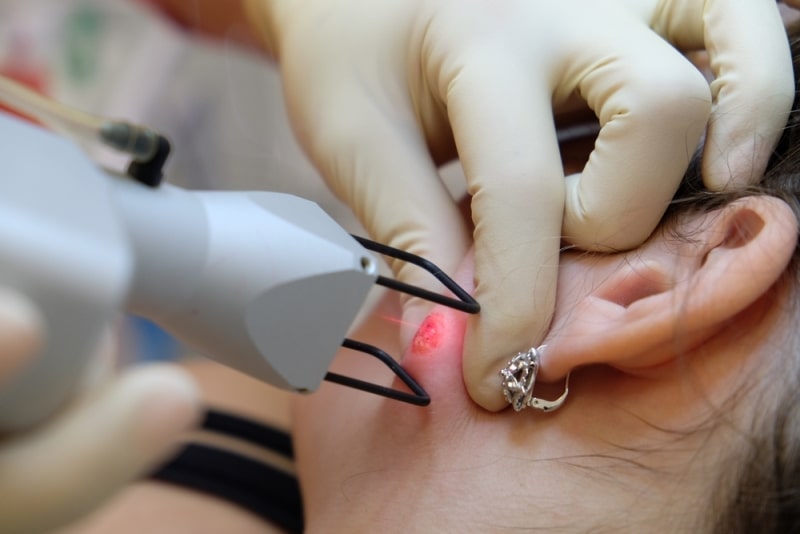 Удаление атеромы лазером