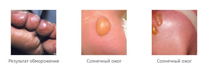 Дерматит фото