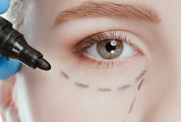 Разметка перед пластикой возле глаза