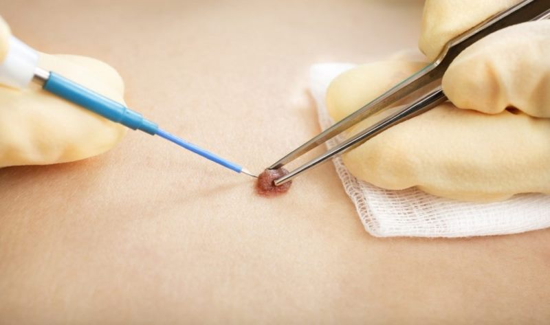 Удаление родинок методом электрокоагуляции