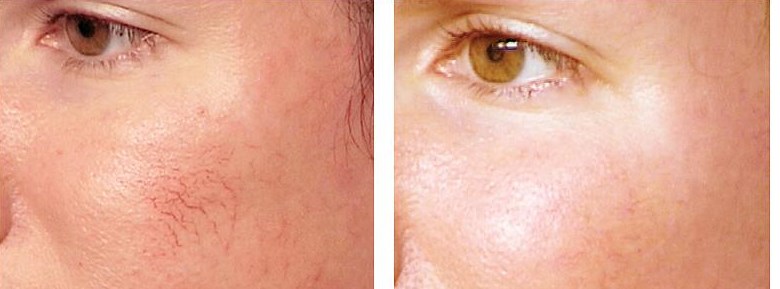 фото до и после удаления