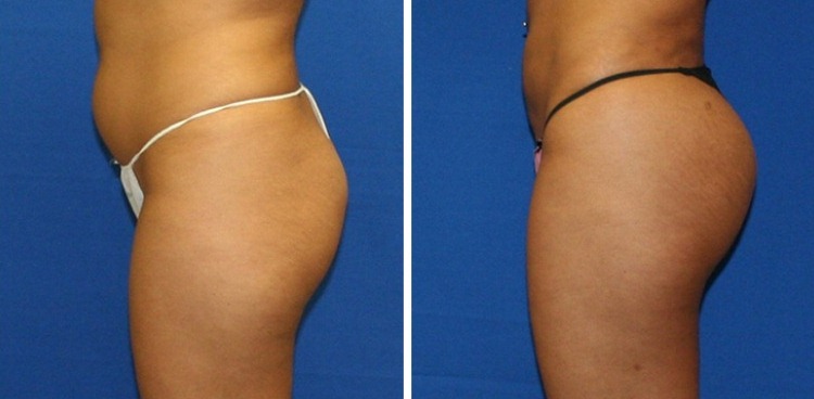 Фото до и после увеличения ягодиц