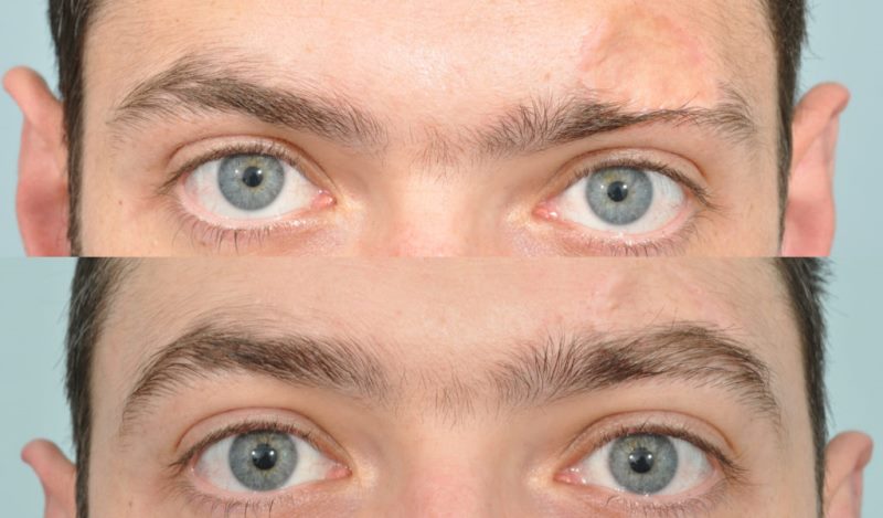 Пересадка бровей: фото до и после