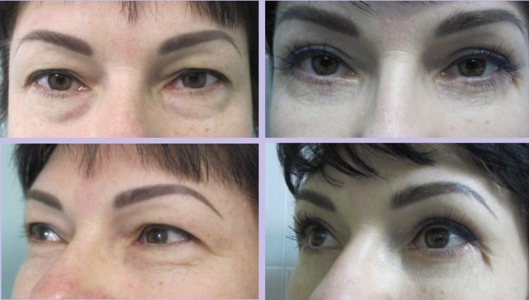 Фото до и после блефаропластики