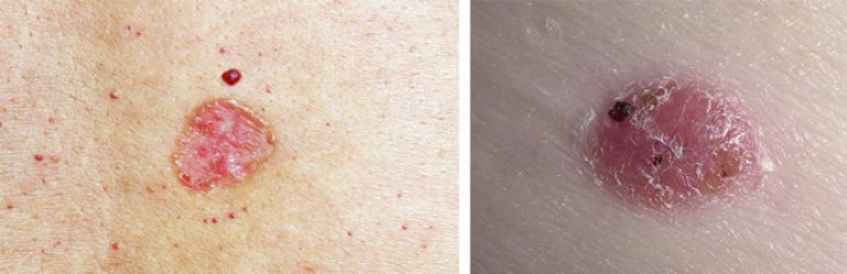 Базалиома кожи лица на фото