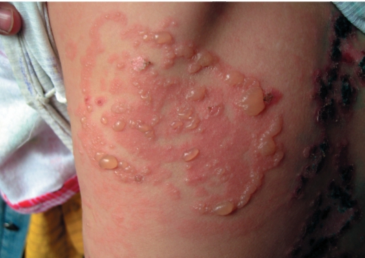 Gerpetiformnyj-dermatit-Dyuringa-foto