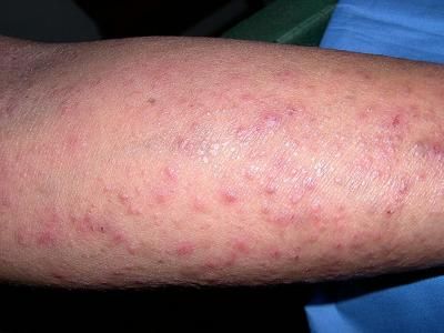 Gerpetiformnyj-dermatit