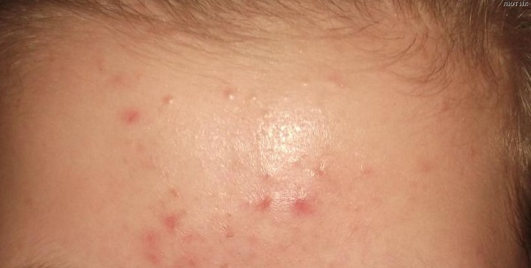 Гормональные прыщи у женщин лечение их медикаментозно и народными методами