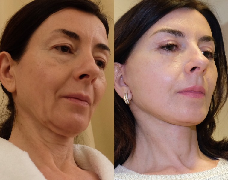 3S-лифтинг от Игоря Белого: фото до и после