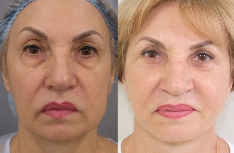 До и после лифтинга лица
