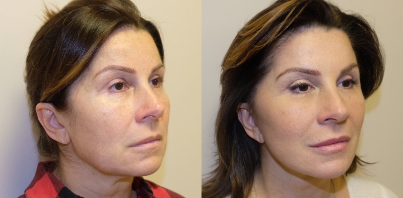 Фото до и после 3S-лифтинга