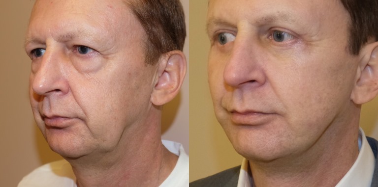 Фото до и после 3S-лифтинга