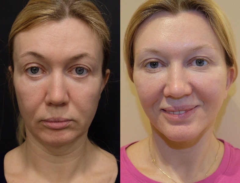 3S-лифтинг от Игоря Белого: фото до и после