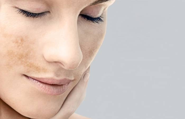 Пятна на лице