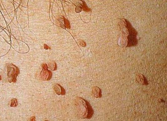 kak-vyglyadit-papilloma