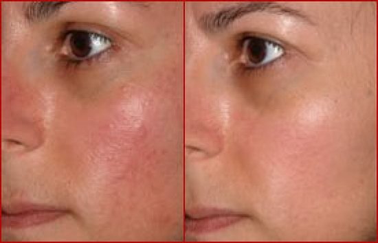 kuperoz-na-lice-prichiny-i-lechenie