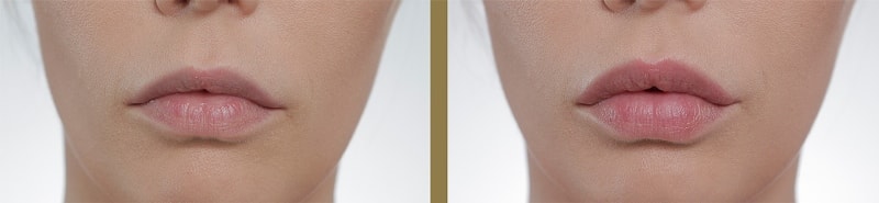 губы до и после